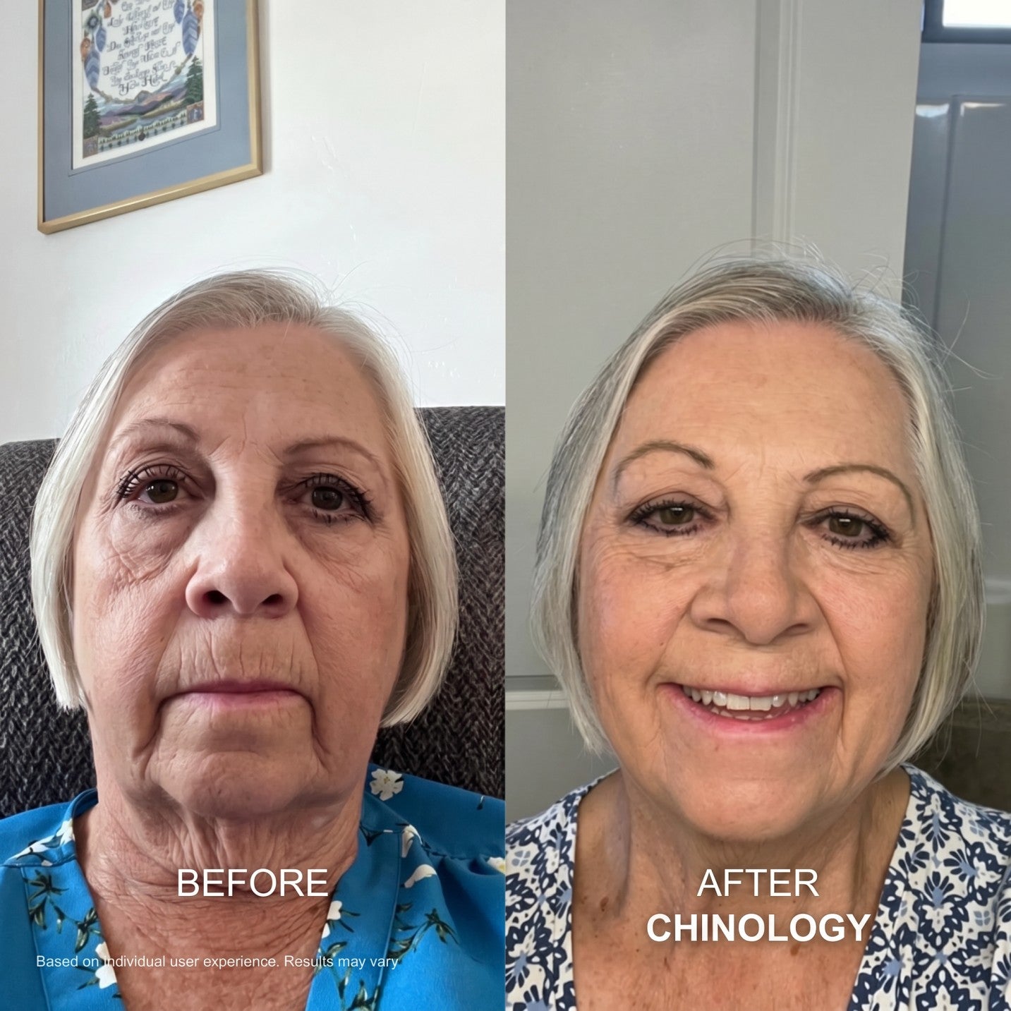 Chinology™ Lift  (New Version - 2026)