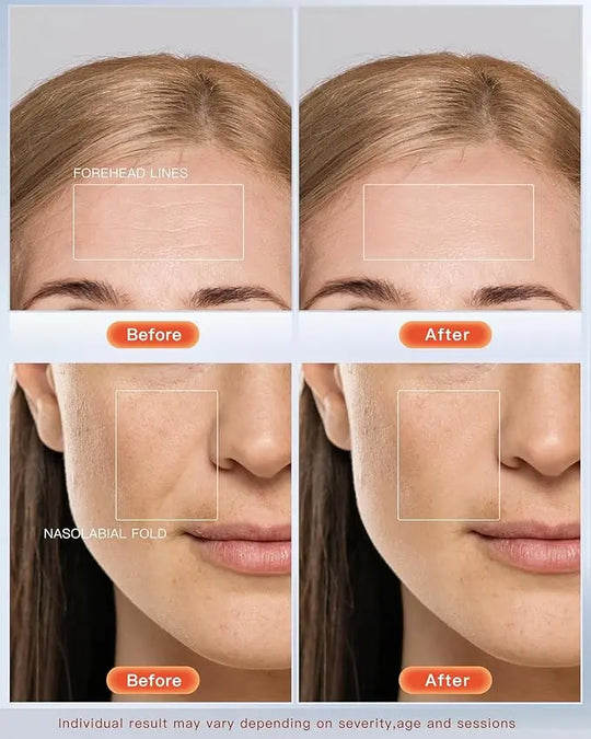 Chinology LED Wrinkle Mask – Eliminate Your Wrinkles Now with Chinology (OFFER EXCLUSIVE TO CUSTOMERS) Chinology™ US