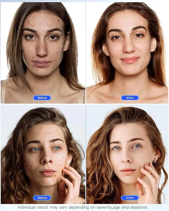 Chinology LED Wrinkle Mask – Eliminate Your Wrinkles Now with Chinology (OFFER EXCLUSIVE TO CUSTOMERS) Chinology™ US